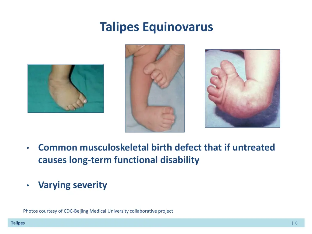 talipes equinovarus 1