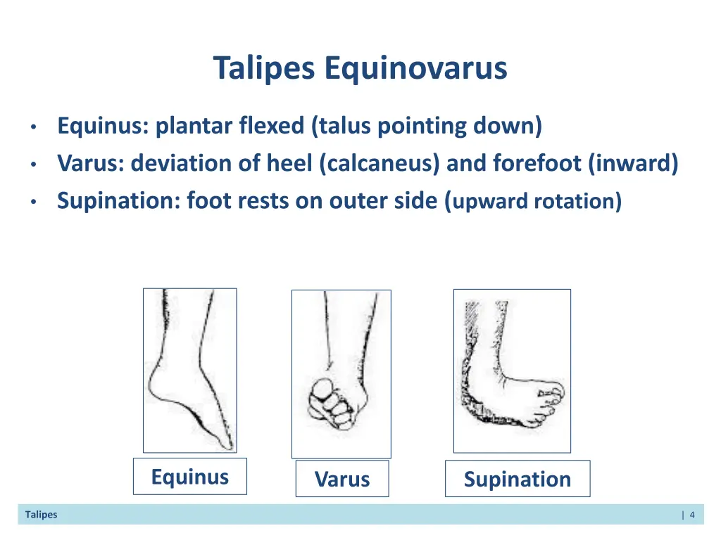 talipes equinovarus