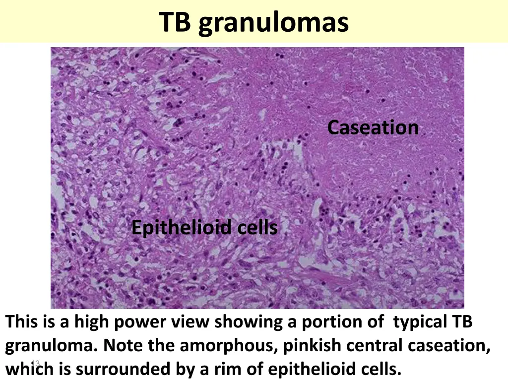 tb granulomas