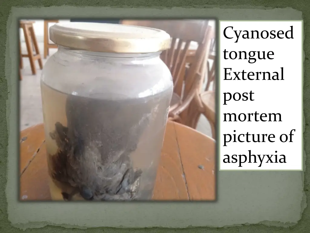 cyanosed tongue external post mortem picture