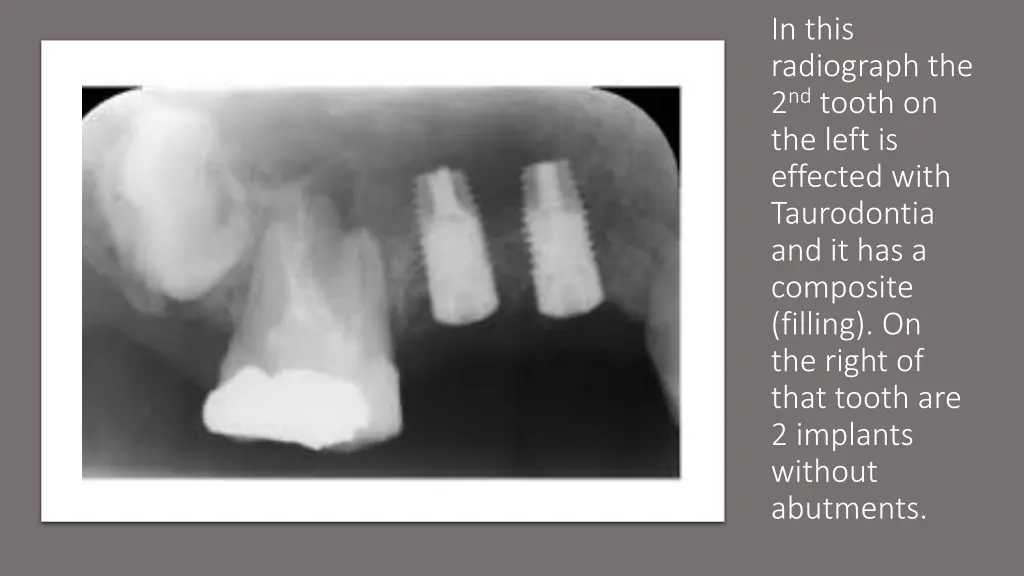 in this radiograph the 2 nd tooth on the left