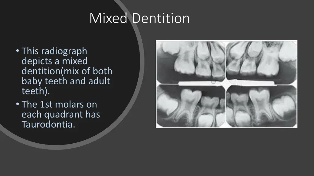 mixed dentition