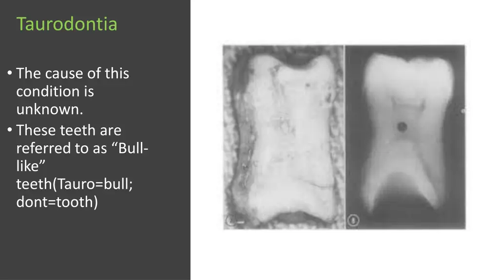taurodontia 1