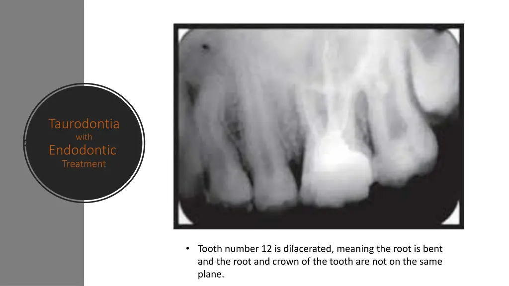 taurodontia with endodontic treatment