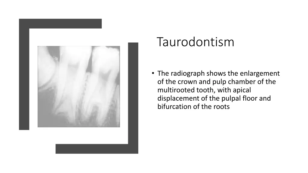 taurodontism