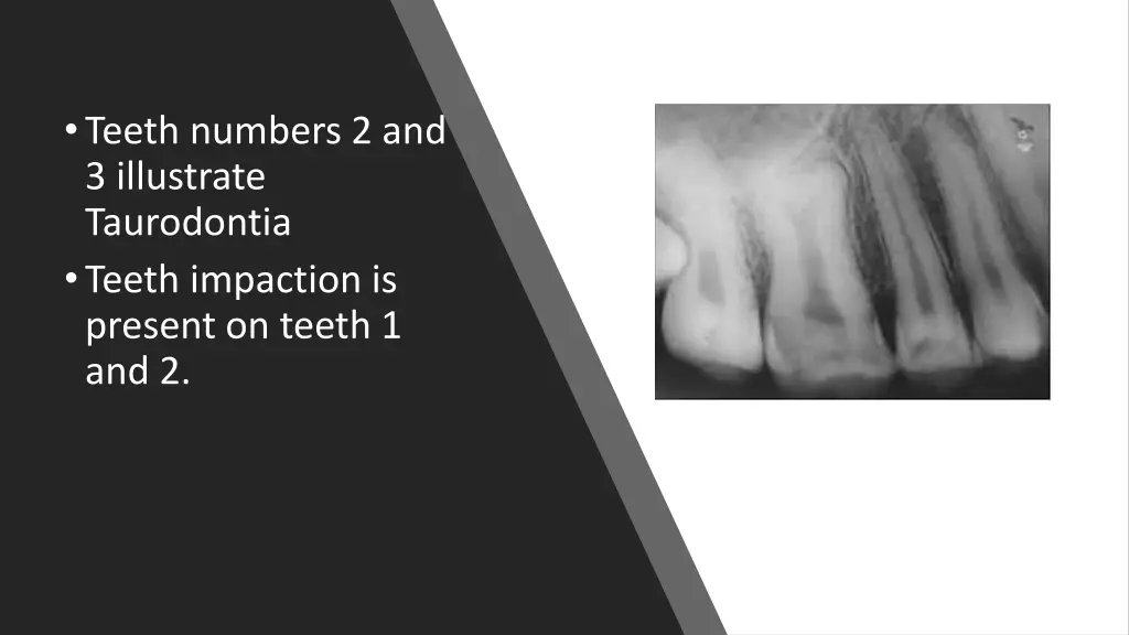 teeth numbers 2 and 3 illustrate taurodontia