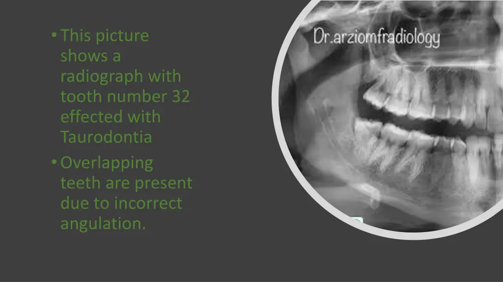this picture shows a radiograph with tooth number