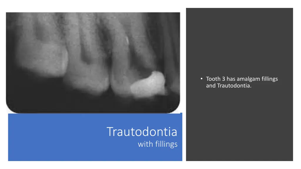 tooth 3 has amalgam fillings and trautodontia