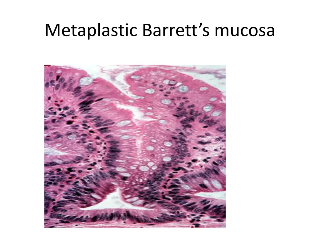 metaplastic barrett s mucosa 1