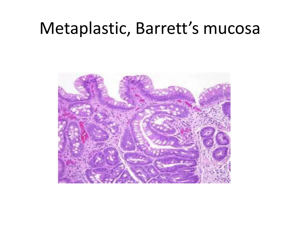 metaplastic barrett s mucosa