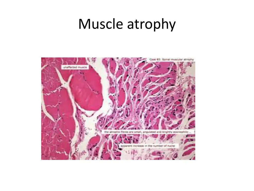 muscle atrophy