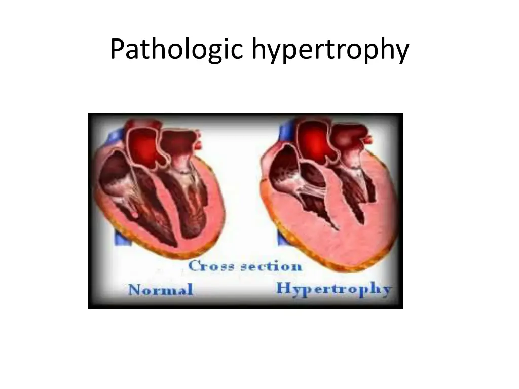 pathologic hypertrophy 1