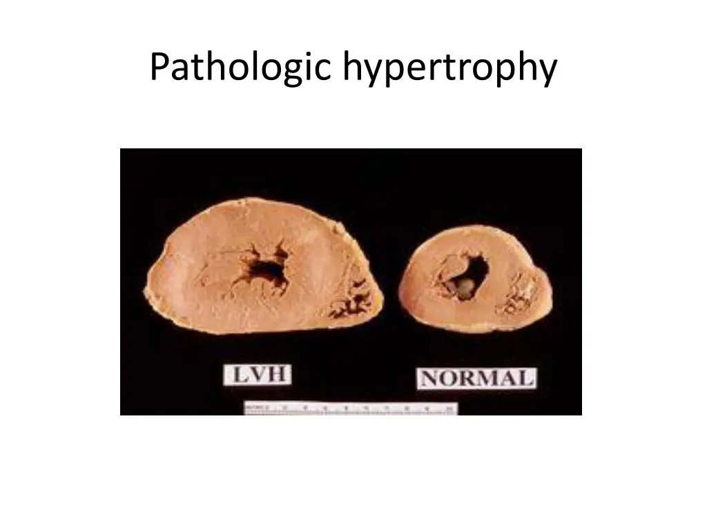 pathologic hypertrophy 2
