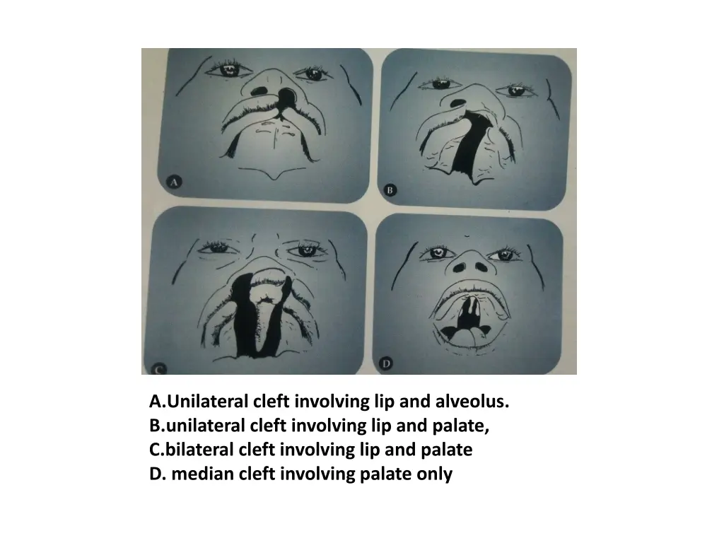 a unilateral cleft involving lip and alveolus