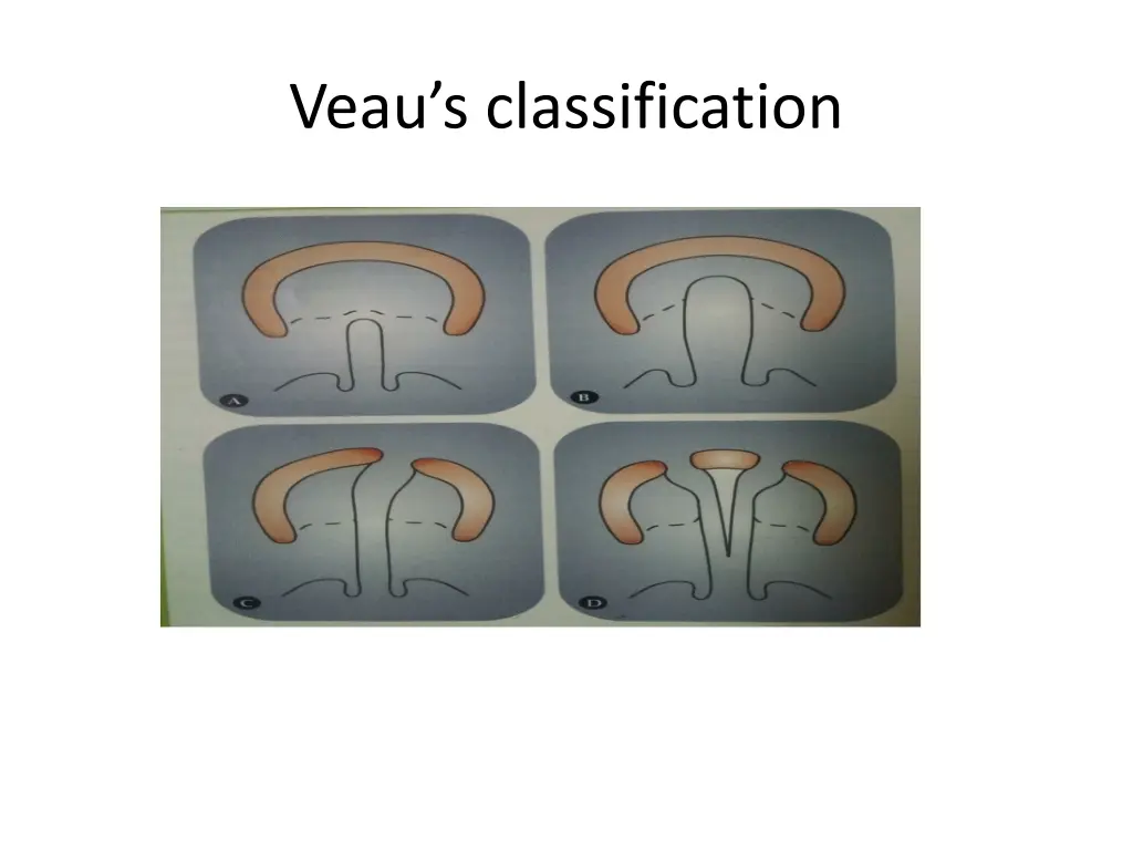 veau s classification