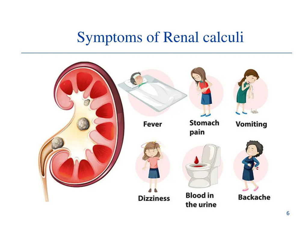 symptoms of renal calculi 1