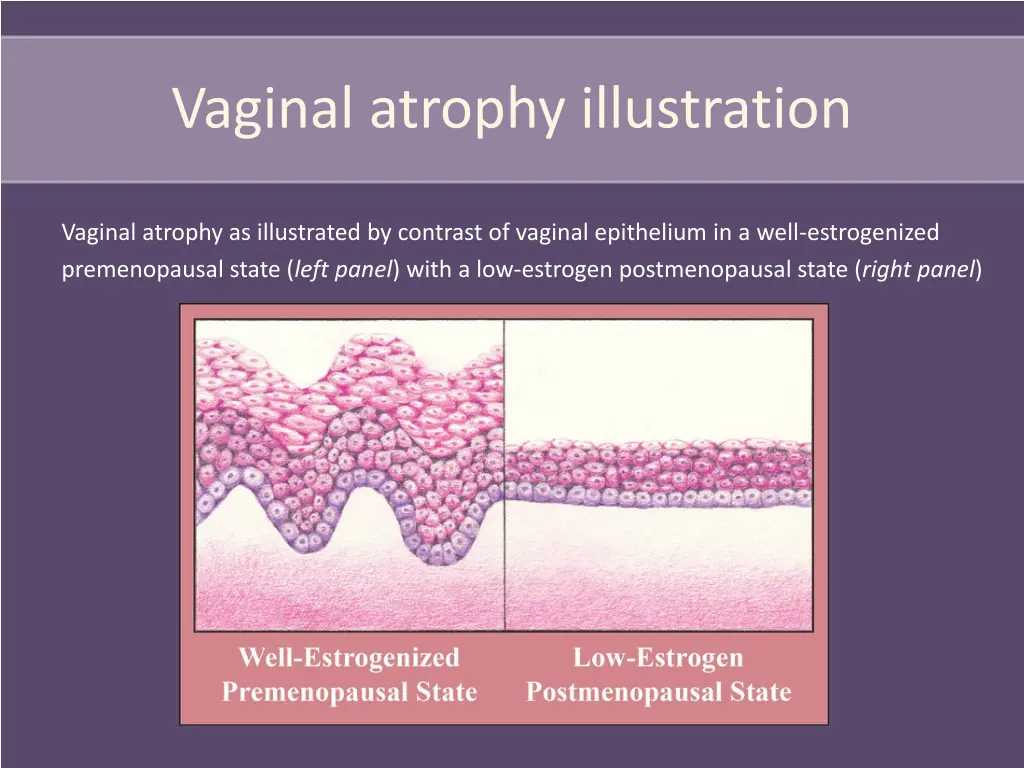 vaginal atrophy illustration