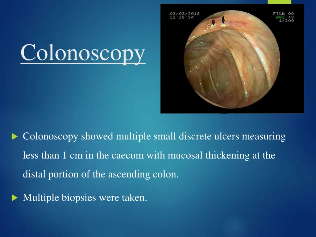 colonoscopy
