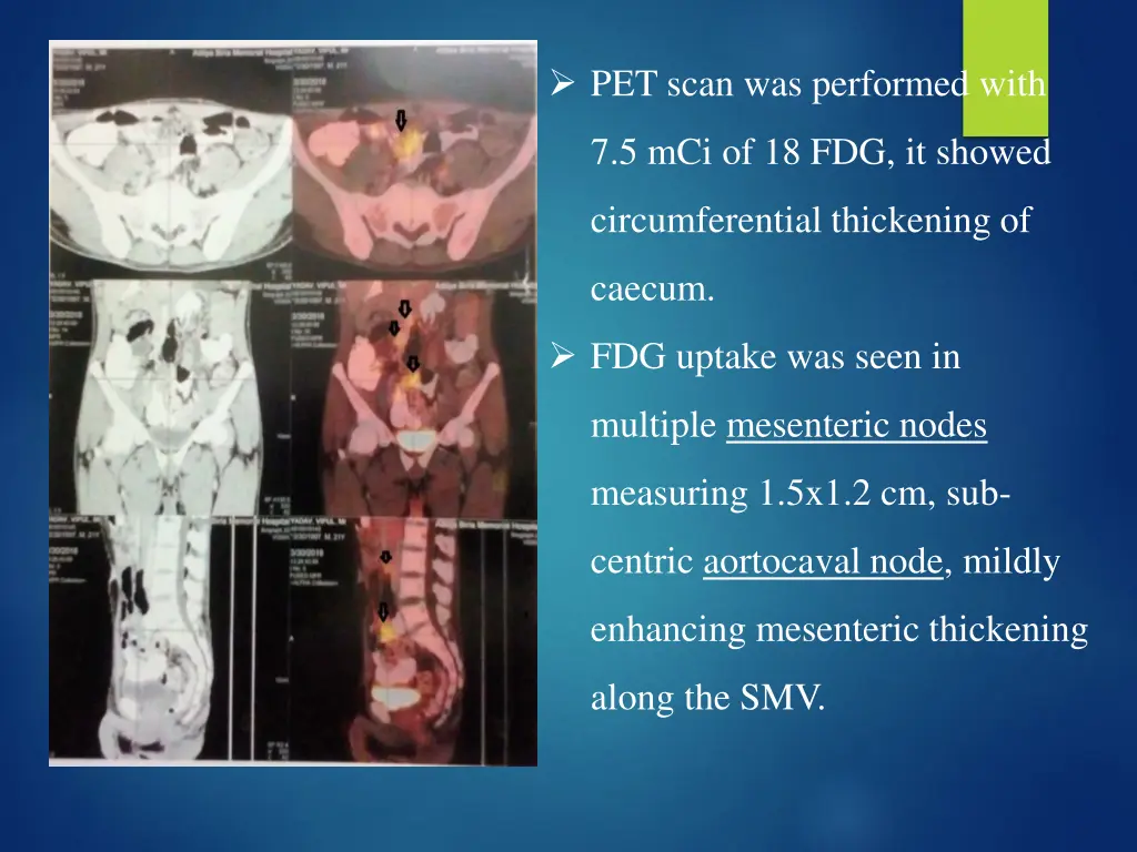 pet scan was performed with