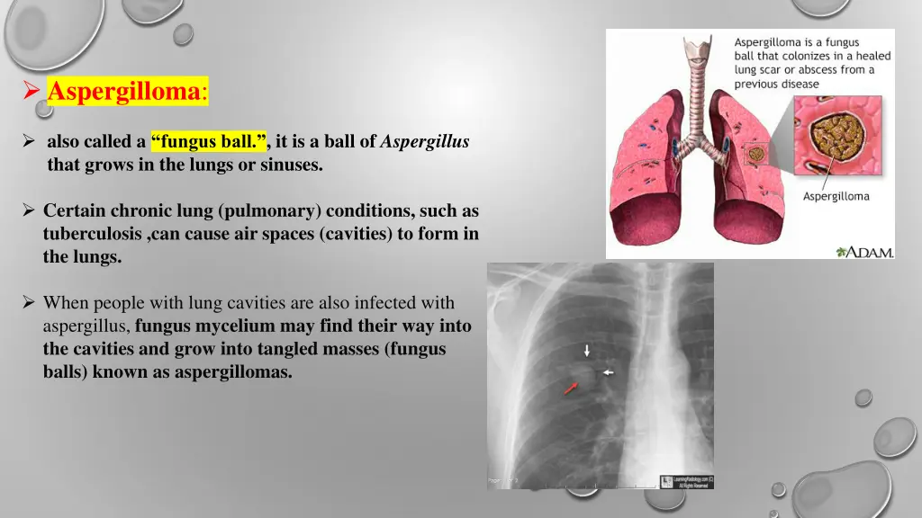 aspergilloma