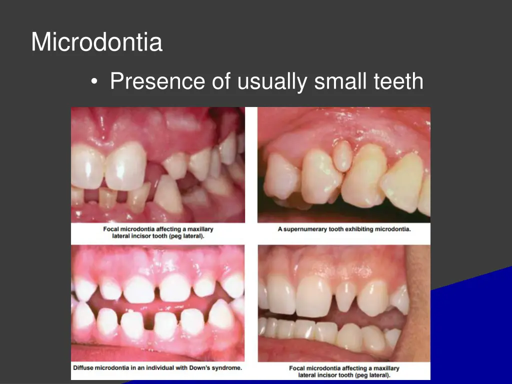 microdontia presence of usually small teeth