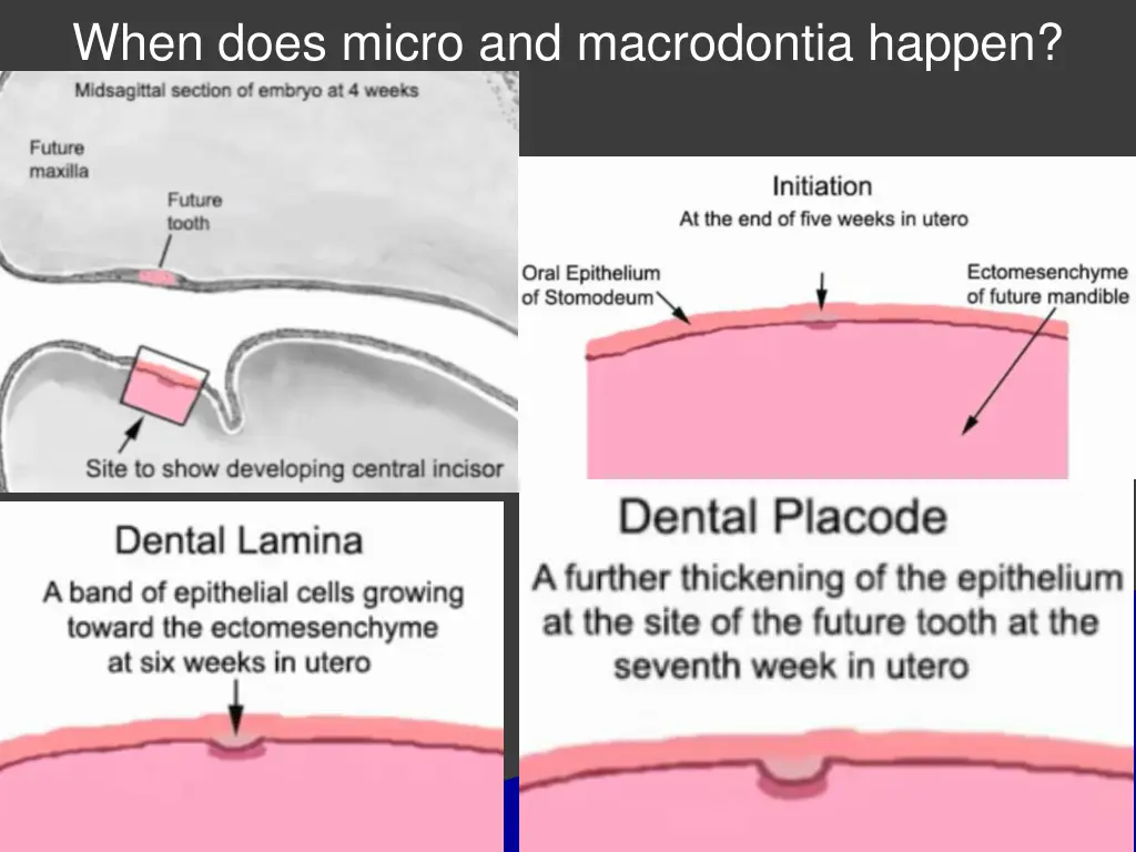 when does micro and macrodontia happen