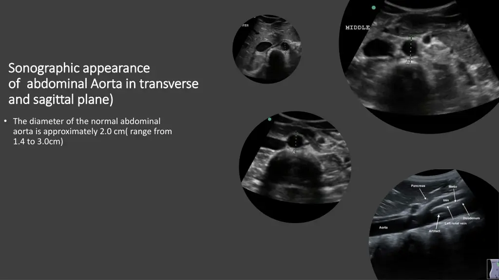 sonographic appearance sonographic appearance