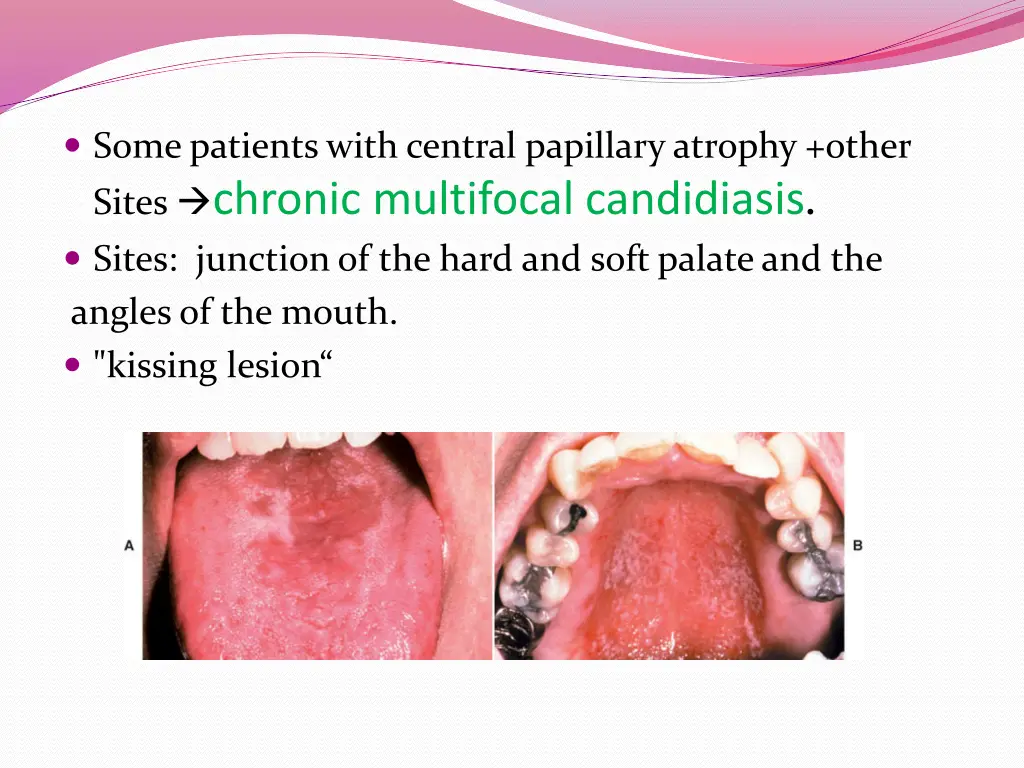 some patients with central papillary atrophy