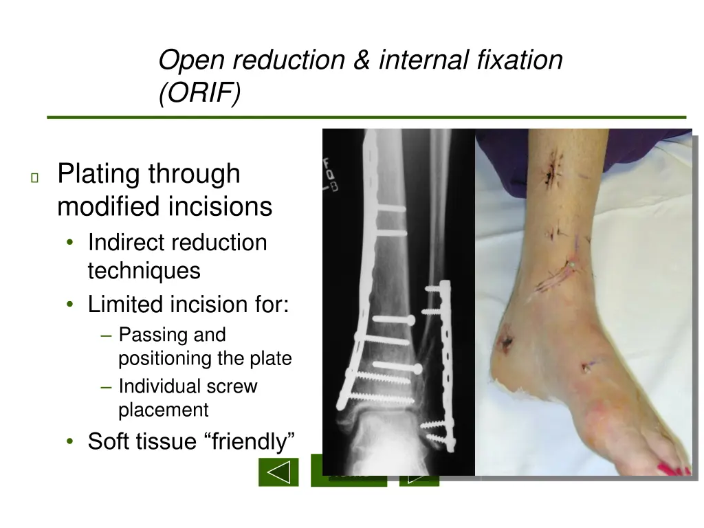 open reduction internal fixation orif