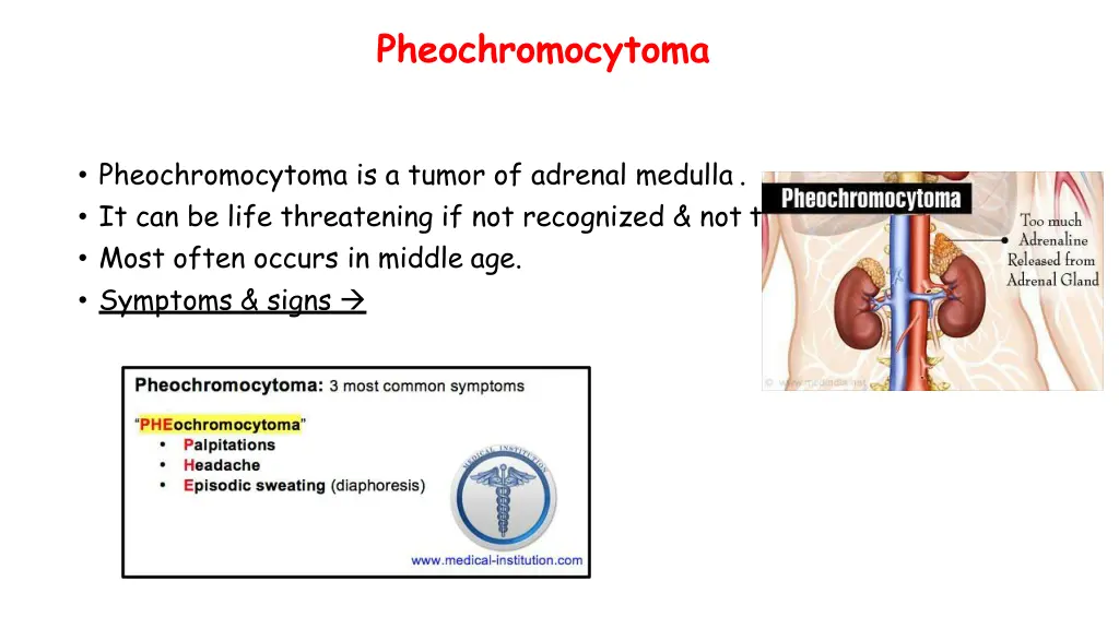 pheochromocytoma