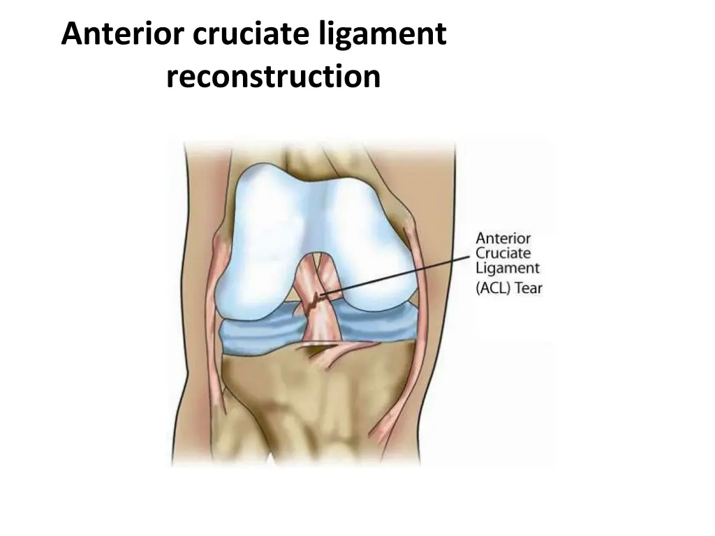 anterior cruciate ligament reconstruction