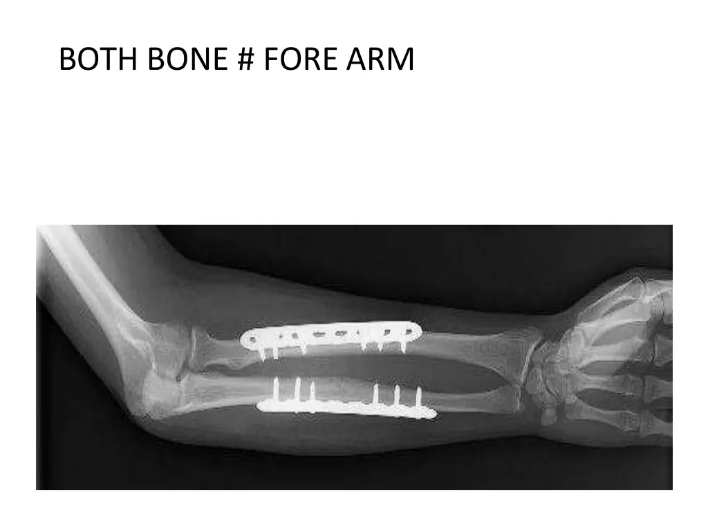 both bone fore arm