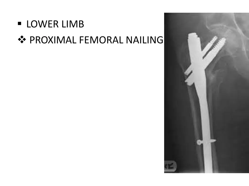 lower limb proximal femoral nailing