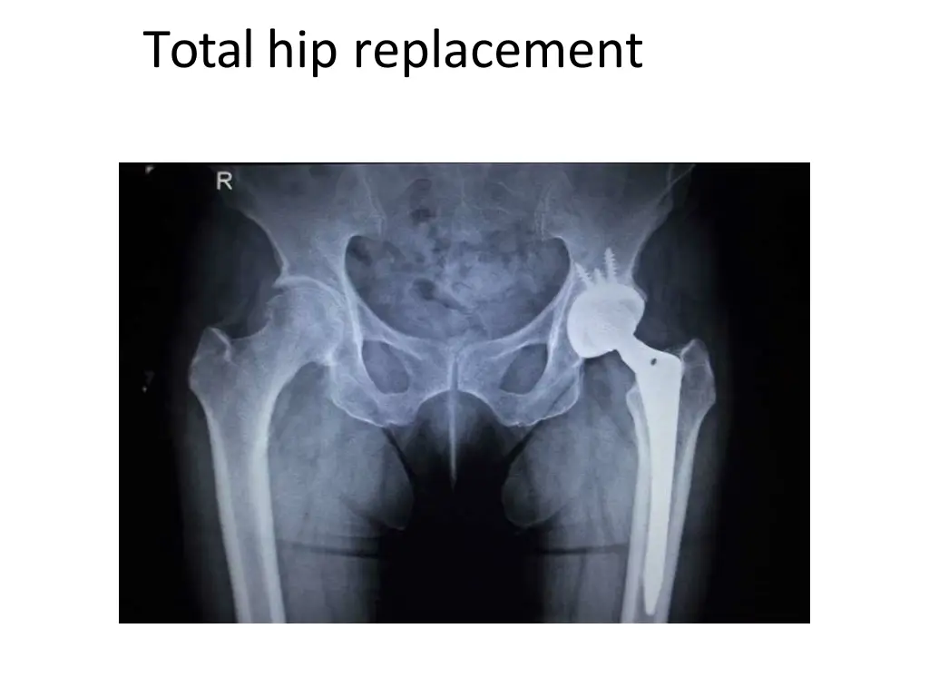 total hip replacement 1