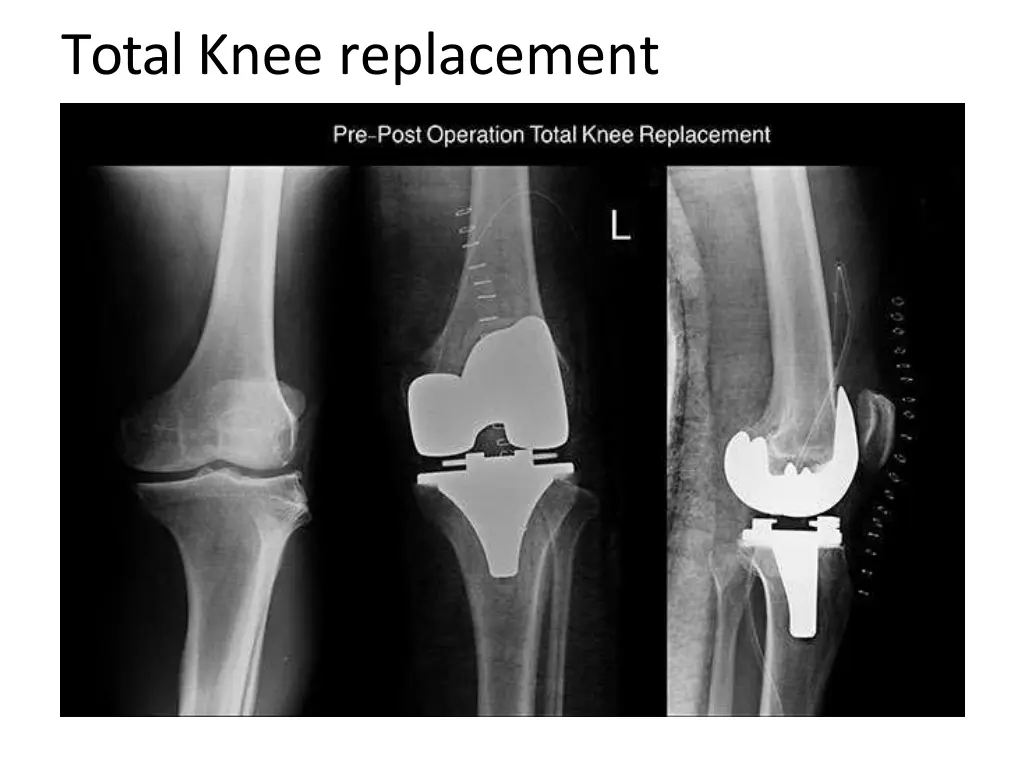 total knee replacement