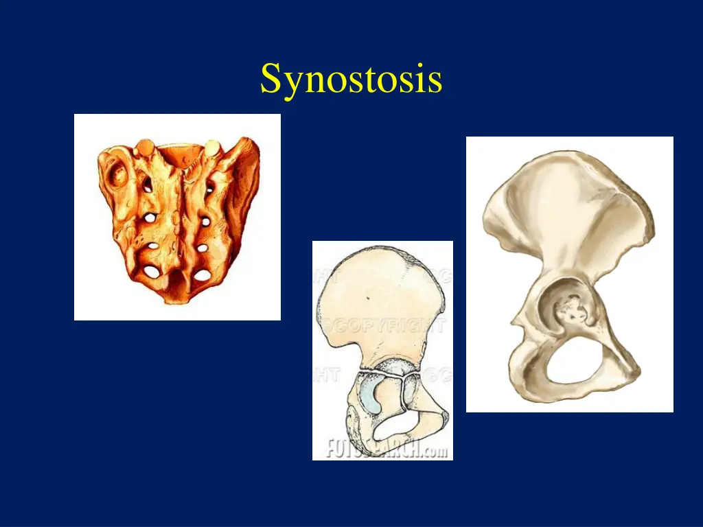 synostosis