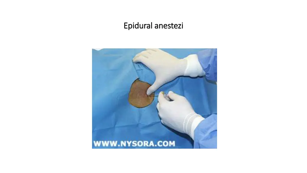 epidural anestezi epidural anestezi 1