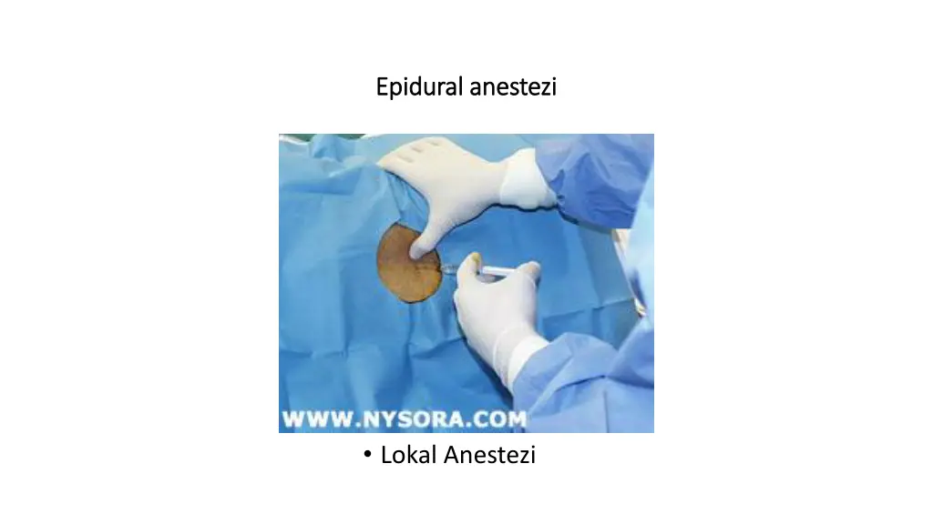 epidural anestezi epidural anestezi