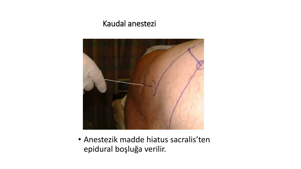 kaudal anestezi kaudal anestezi