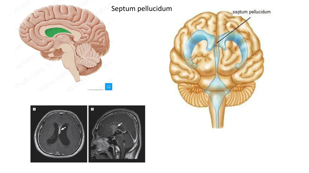septum pellucidum