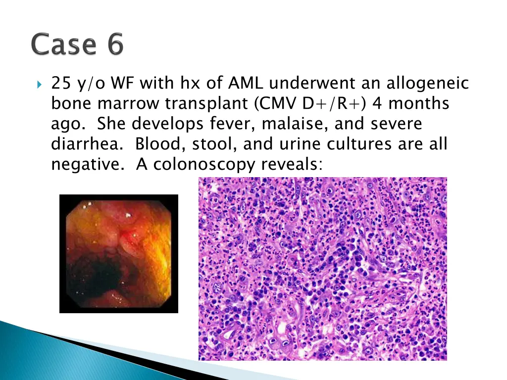 25 y o wf with hx of aml underwent an allogeneic