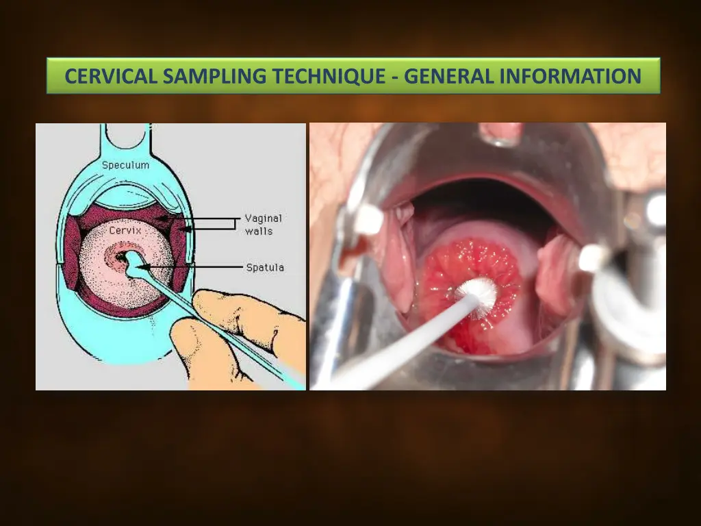cervical sampling technique general information 4