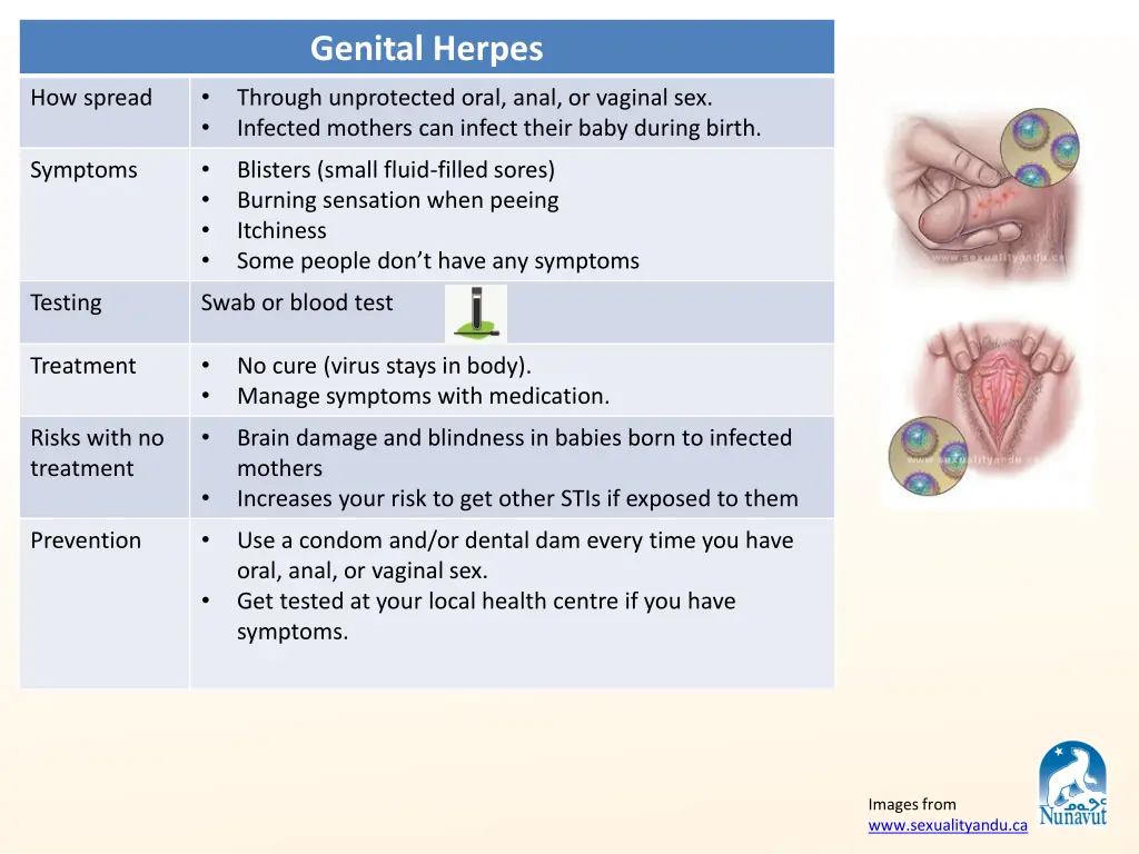 genital herpes