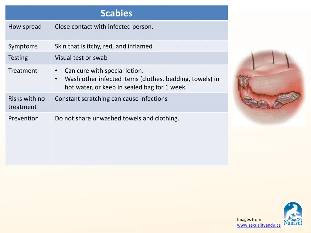 scabies