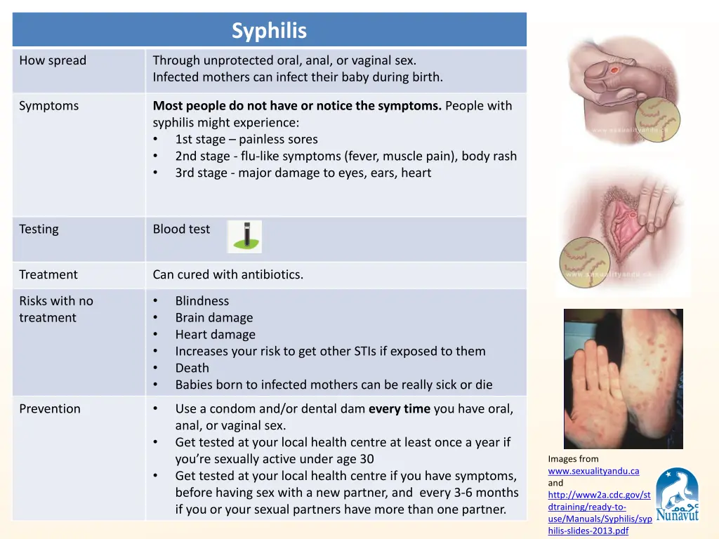 syphilis