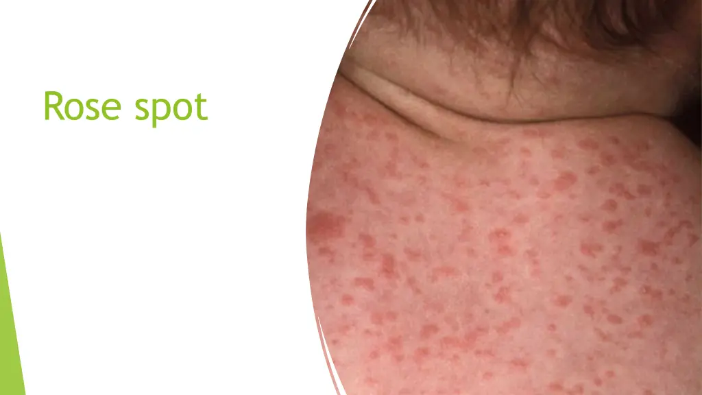 rose spot