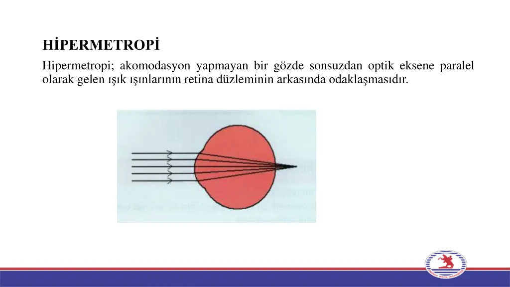 h permetrop hipermetropi akomodasyon yapmayan