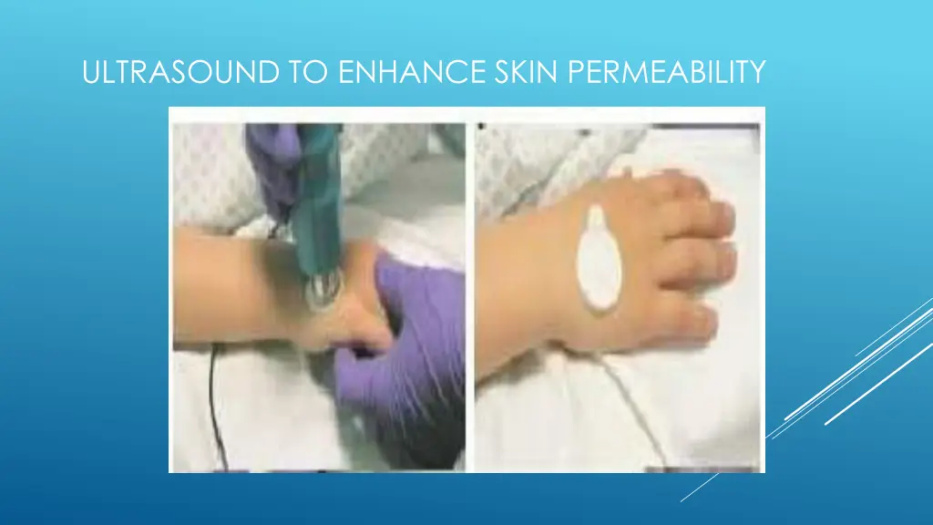 ultrasound to enhance skin permeability