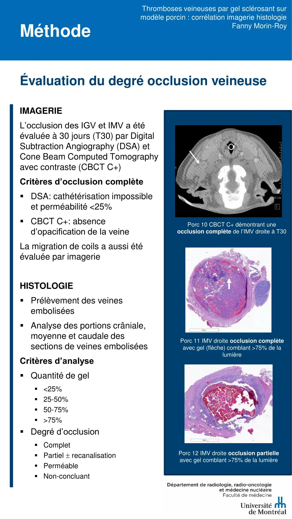 thromboses veineuses par gel scl rosant 3