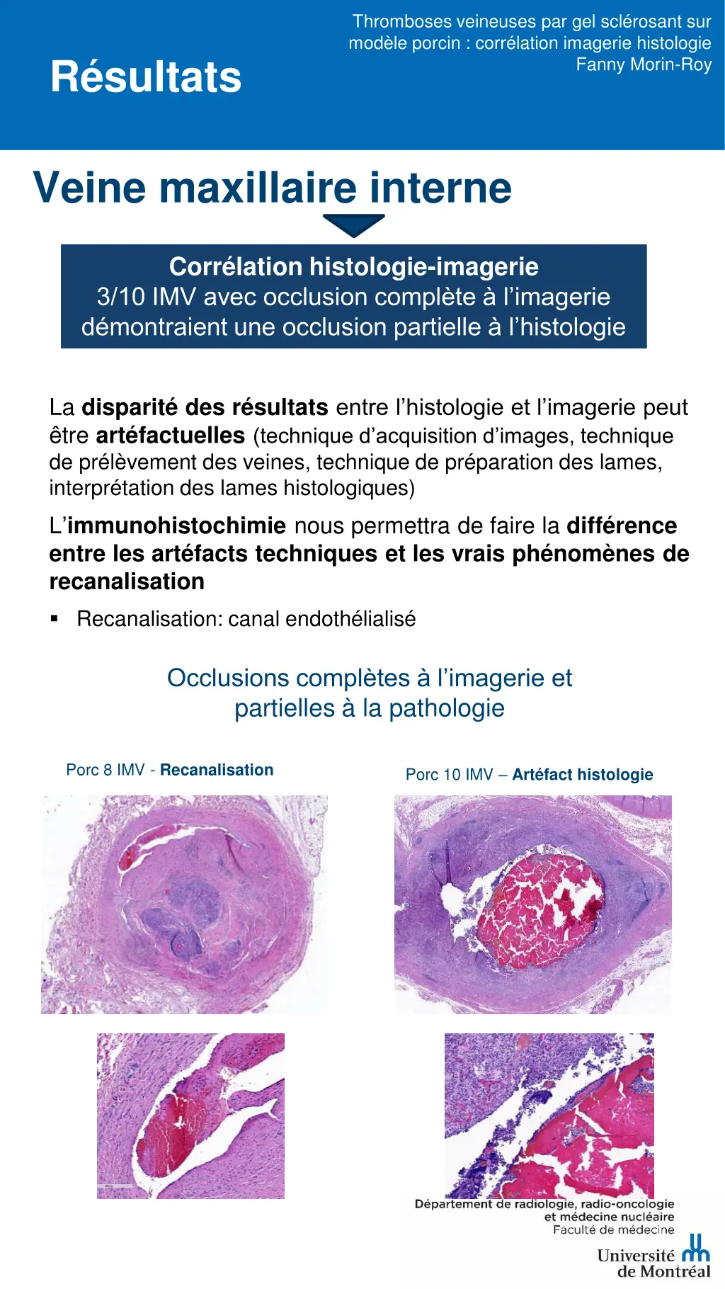 thromboses veineuses par gel scl rosant 6